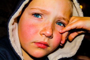 八个月助孕包生男孩脸上起红点的原因与护理